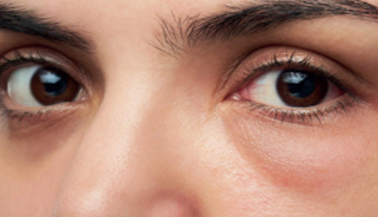 7 Yoga Exercises To Get Rid Of Puffy Eyes