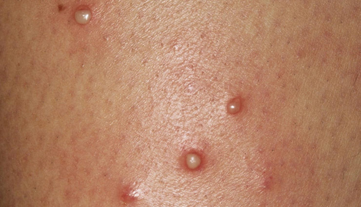 बारिश के दिनों में पनपती है फोड़े फुंसियों की समस्या, इन उपायों की मदद से पाए राहत