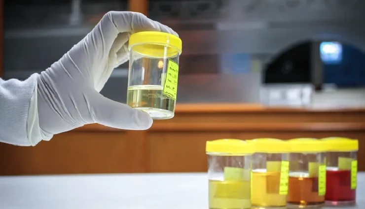 10 Home Remedies Get Rid of Excess Pus Cells in The Urine