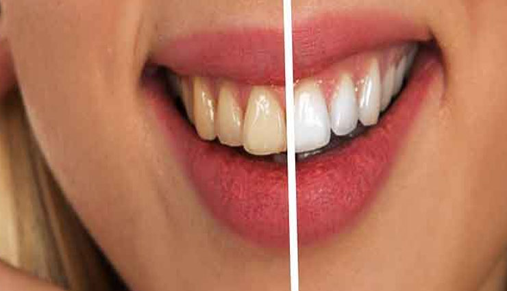 दांत हो चुके है पायरिया का शिकार, करें इन 4 प्राकृतिक तरीकों से उपचार