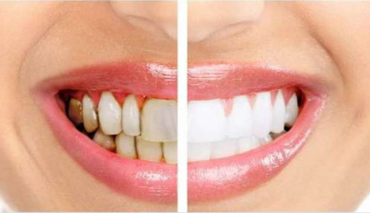 दांतों से जुड़ी है पायरिया की बीमारी, उपचार के लिए आजमाए ये 4 प्राकृतिक तरीकें 