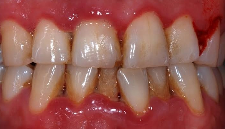 मोतियों जैसे चमकेंगे दांत, मुंह की बदबू से भी मिलेगा छुटकारा, बस करना होगा ये काम neem stick dental benefits,neem twigs oral health advantages,benefits of using neem datun,neem twig for dental hygiene,neem toothbrush health benefits,neem twig oral care perks,neem datun benefits for teeth,neem stick for oral hygiene,dental benefits of neem twigs,neem twig advantages for oral health,नीम दातून के लाभ,नीम की ट्विग के फायदे,नीम टूथब्रश के फायदे,दांतों के लिए नीम की ट्विग,नीम दातून स्वास्थ्य लाभ,नीम का टूथब्रश लाभ,नीम ट्विग से ऑरल केयर,नीम की ट्विग दांतों के लिए,नीम डेंटल केयर बेनिफिट्स,नीम ट्विग के स्वास्थ्य लाभ