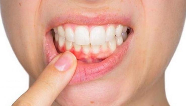 ये 4 प्राकृतिक तरीकें दूर करेंगे पायरिया की बिमारी, बनाएंगे दांतों को स्वस्थ