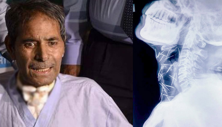 news,56-year-old man with 150 pins in neck,rajasthani man with 150 needles,mental disorder
