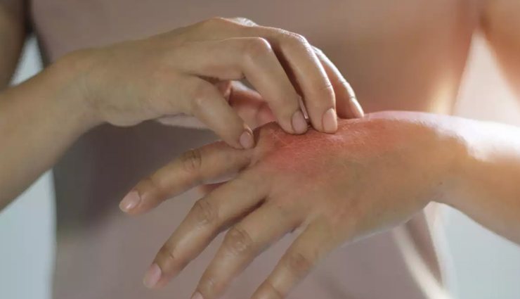 10 Natural Ways To Treat Rashes