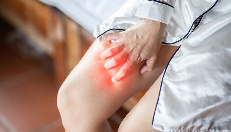 12 Home Remedies To Get Rid of Rashes on Inner Thighs