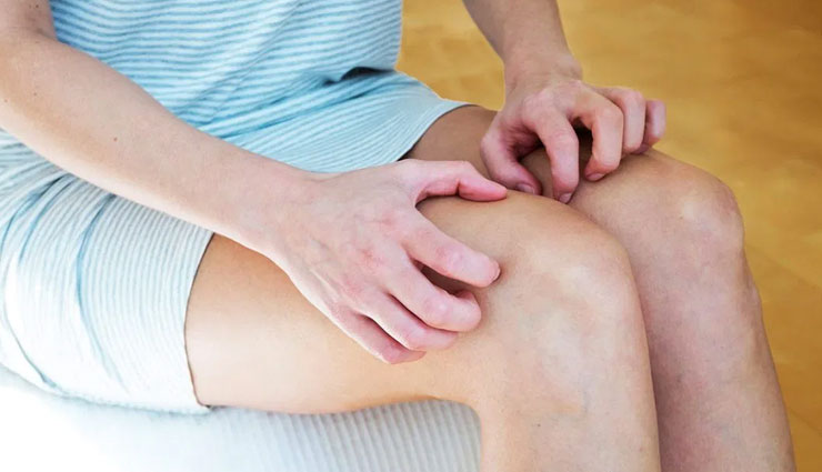 5 Natural Ways To Treat Rashes on Inner Thighs