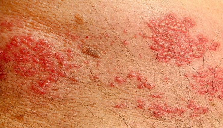 clove oil side effects,negative effects of clove oil,clove oil health risks,adverse reactions to clove oil,dangers of clove oil,clove oil toxicity,clove oil allergic reactions,clove oil overdose,clove oil poisoning,harmful effects of clove oil on health,clove oil adverse effects,clove oil precautions,clove oil safety concerns,clove oil allergic sensitivity,clove oil overdose symptoms,risks of using clove oil,clove oil side effects on skin,clove oil ingestion dangers,clove oil topical reactions,clove oil inhalation hazards