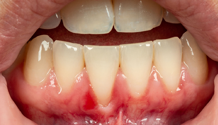 8 Effective Home Remedies To Treat Receding Gums