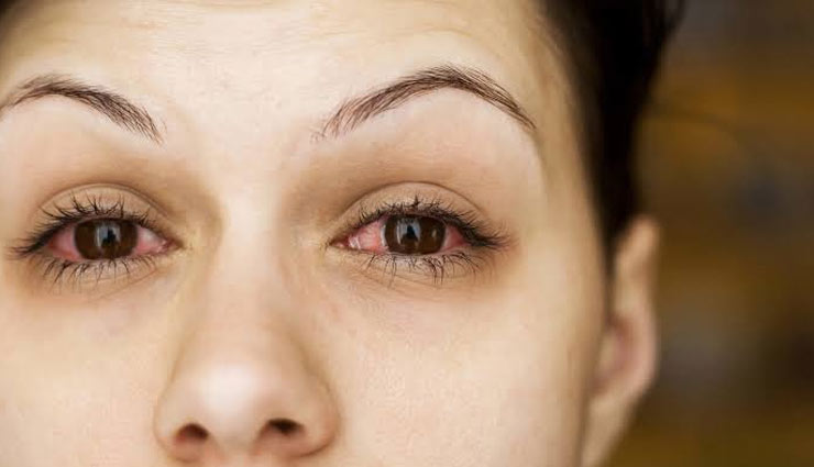 5 Ways To Get Rid of Red Eyes