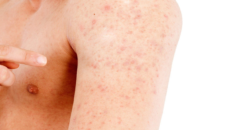 क्या आपके शरीर पर भी निकल आते है बारीक लाल रंग के चकते, आजमाए ये उपाय
