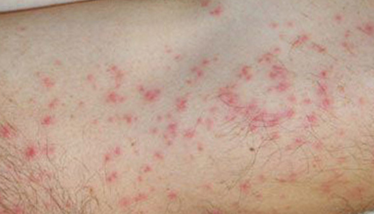 beauty tips,beauty tips in hindi,red pimple in summer,home remdies