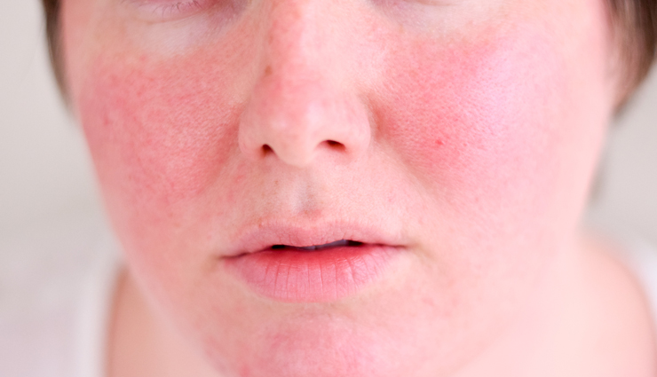 dark circles,acne,the best concealer for every skin problem,blemishes,redness