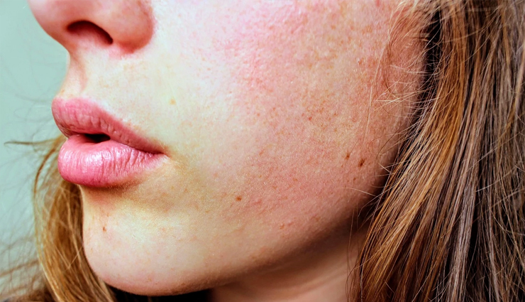 6 Homemade Face Mask For Redness