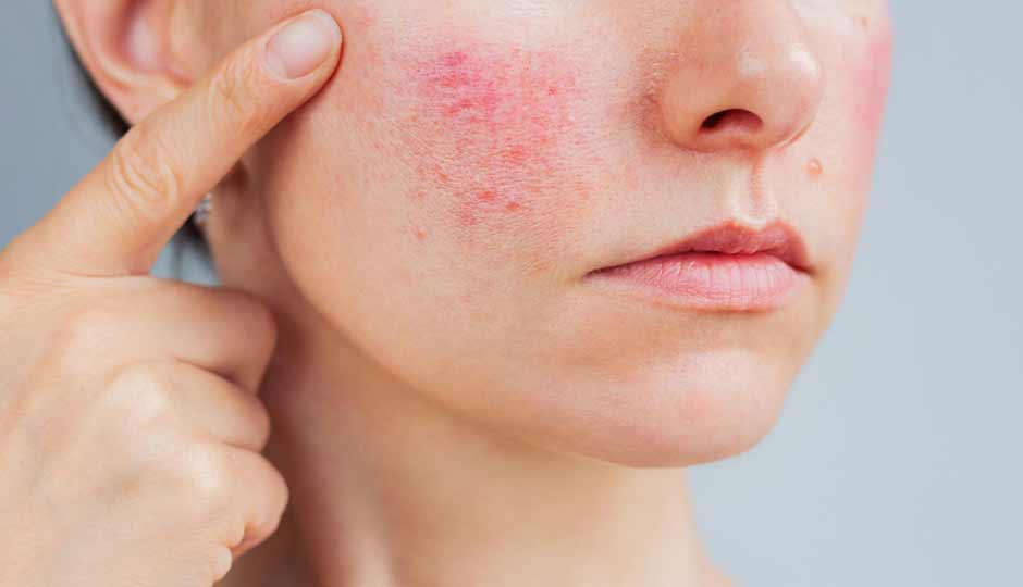 10 Home Remedies To Treat Redness on Skin