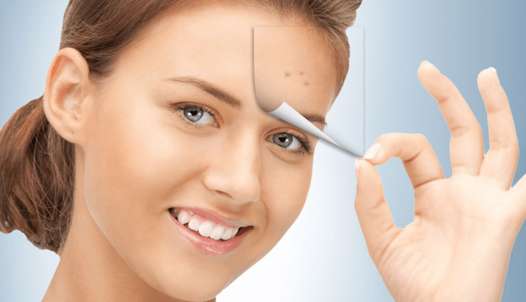 remedies to treat acne,home remedies,acne tips,beauty tips,skin care tips