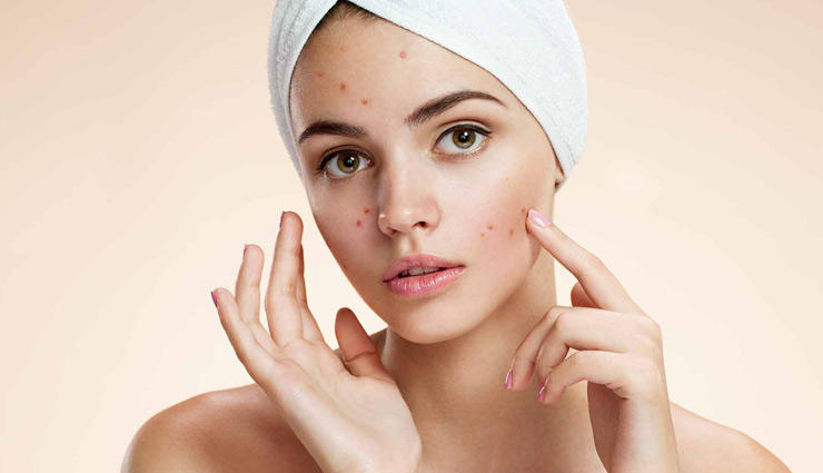 remedies for acne,home remedies,acne tips,valentines special,beauty tips,skin care tips