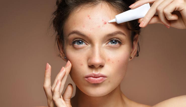 home remedies,home remedies for acne,skin care tips,tips to get rid of pimples,beauty tips