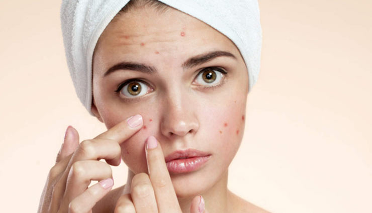 home remedies,home remedies for acne,acne removal tips,skin care tips,beauty tips