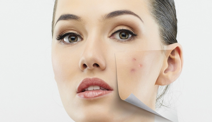 Valentines Special- 5 Super Fast Ways To Get Rid of Acne