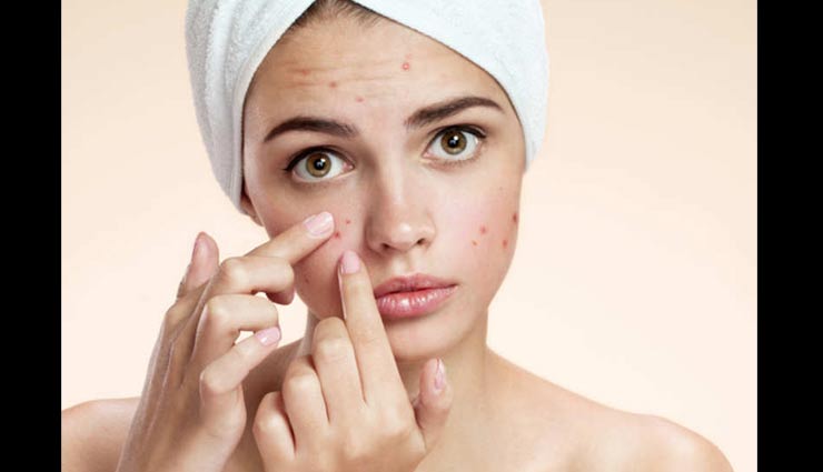 home remedies,home remedies for acne,skin care tips,tips to get rid of pimples,beauty tips