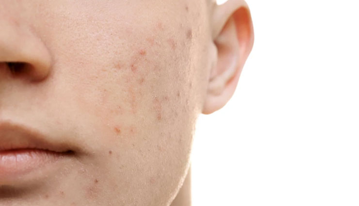 home remedies,home remedies for acne scars,acne scars,coconut oil,lemon juice,aloe vera,cucumber,sugar scrub