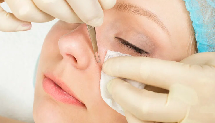 5 Home Remedies To Get Rid of Blackheads