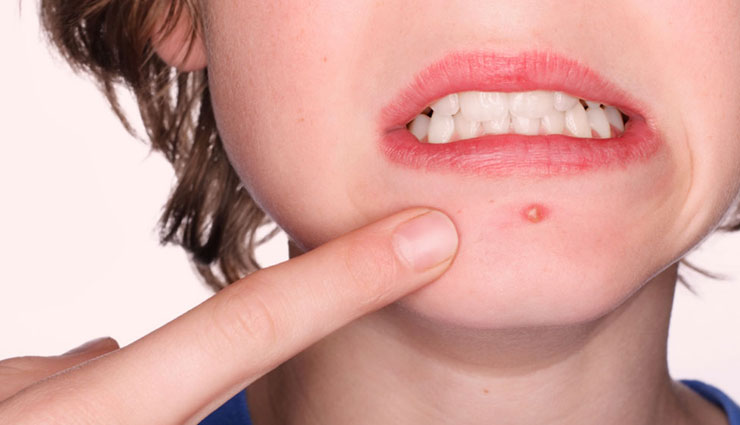 home remedies,home remedies to treat boils,boils,Health tips,fitness tips