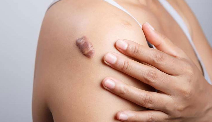 home remedies,home remedies to treat boils,boils,Health tips,fitness tips