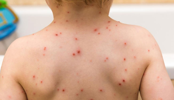 chickenpox,home remedies to treat  chickenpox,home remedies,Health tips,fitness tips