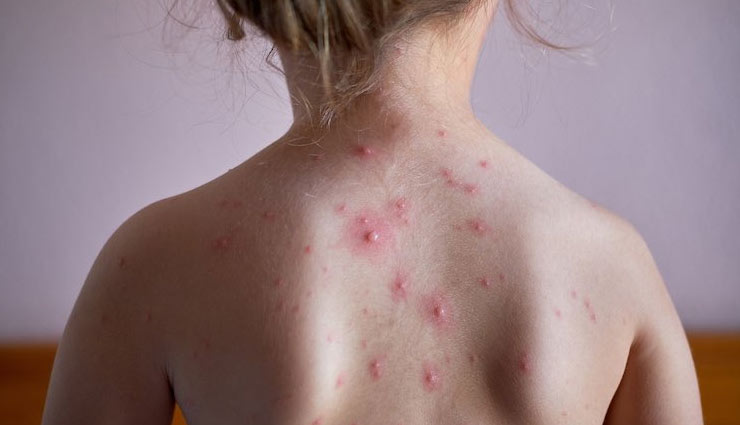 5 Home Remedies To Treat Chickenpox