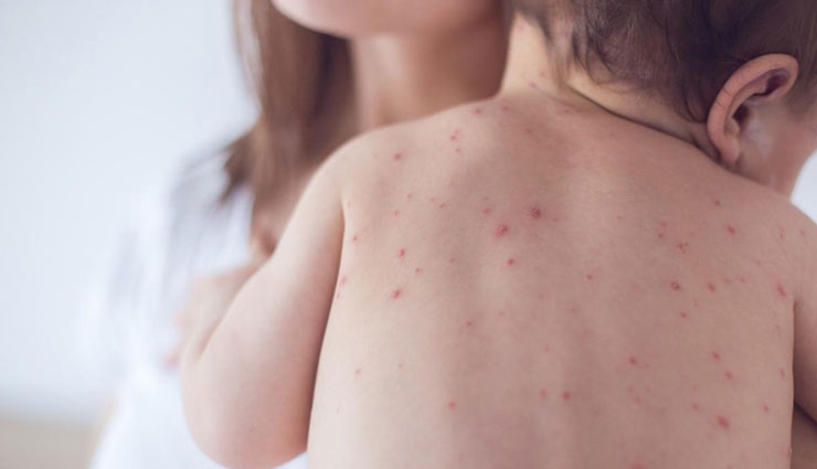 chickenpox,home remedies to treat  chickenpox,home remedies,Health tips,fitness tips