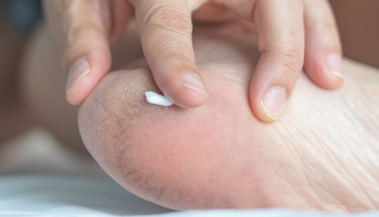 5 Easy Home Remedies To Treat Crack Heels