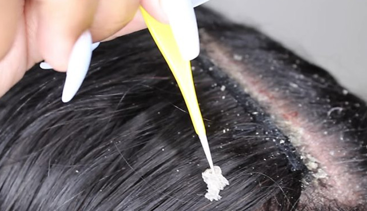 डैंड्रफ बनता जा रहा है बालों के लिए बड़ी समस्या, इन उपायों की मदद से करें उपचार