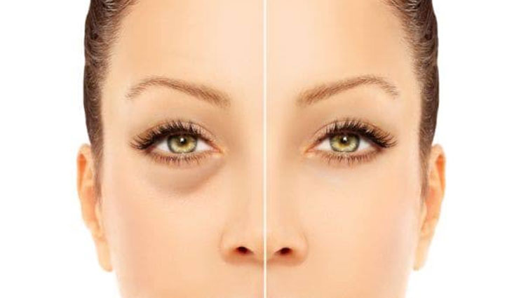 5 Home Remedies To Get Rid of Dark Circles