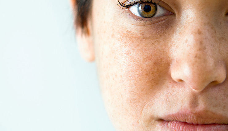 5 Home Remedies To Get Rid of Dark Spots