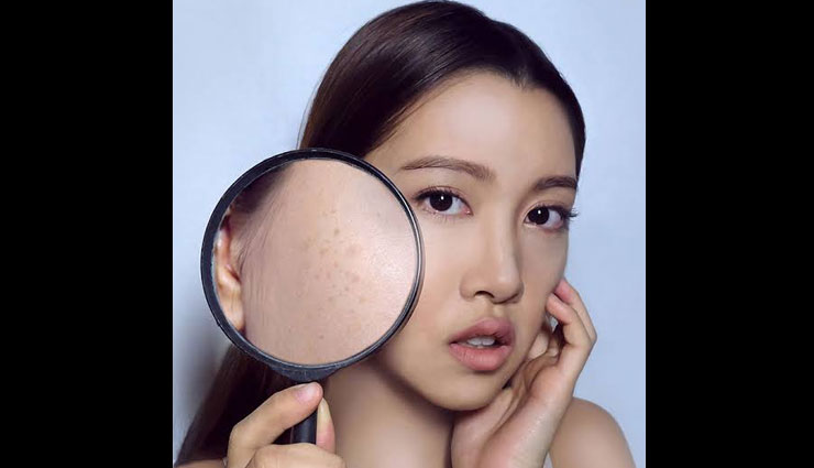 5 Easy Remedies To Get Rid of Dark Spots