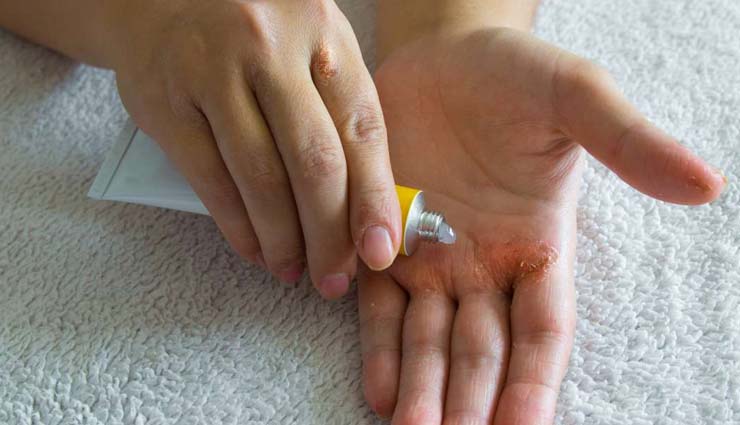 5 Effective Remedies To Treat Dermatitis