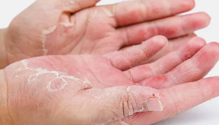 effective remedies for dermatitis,dermatitis,Health tips,home remedies