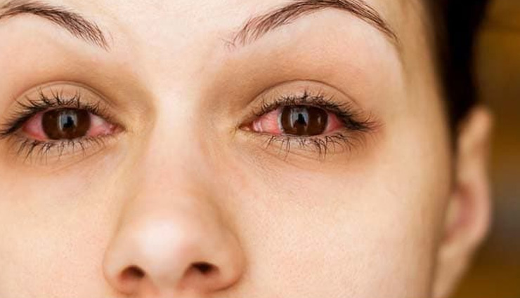 आई फ्लू देता है आँखों में जलन, इससे राहत पाने के लिए अपनाए ये 4 उपाय 