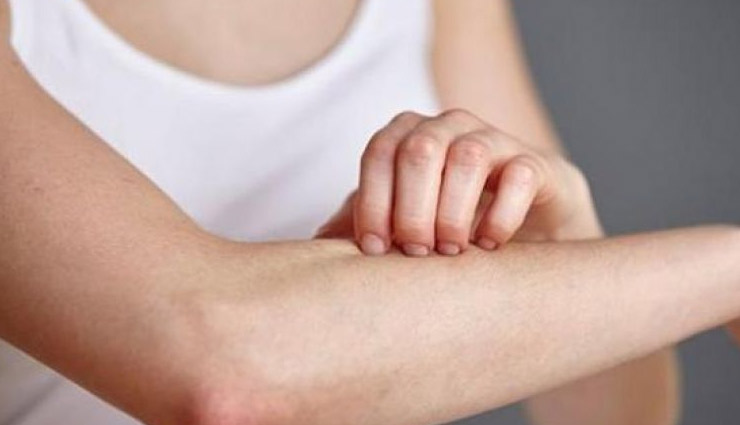 बारिश के दिनों अक्सर रहती है फंगल इंफेक्शन की शिकायत, काबू पाने के लिए करे ये घरेलू उपाय