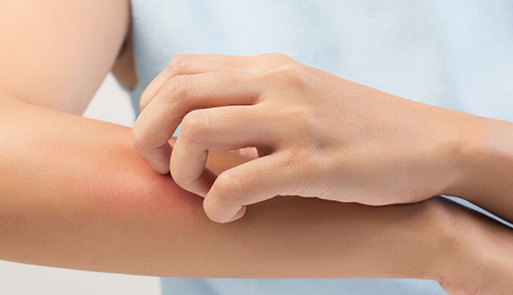 फंगल इन्फेक्शनकी परेशानी बनती है बहुत दुखदायी, इन 5 तरीको की मदद से जल्द पाए छुटकारा