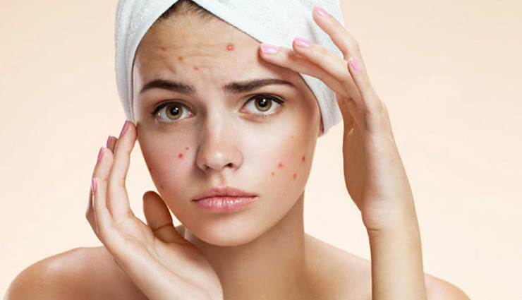 tips to treat  pimples,home remedies,skin care tips,beauty tips