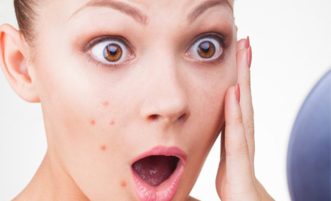 tips to treat  pimples,home remedies,skin care tips,beauty tips