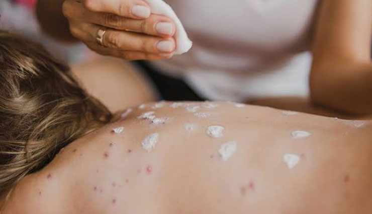 5 Home Remedies To Treat Skin Allergy