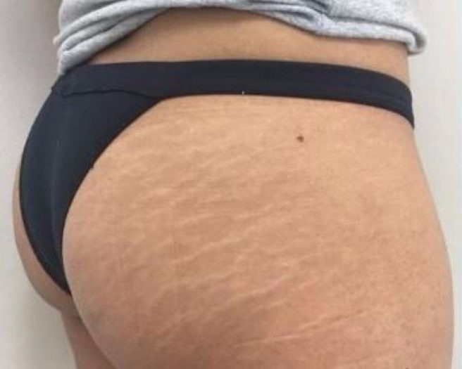 stretch marks,stretch marks for stretch marks,get rid of stretch marks,skin care tips,beauty tips
