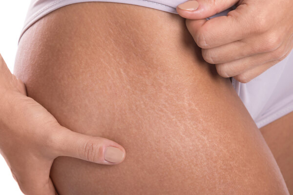 stretch marks,stretch marks for stretch marks,get rid of stretch marks,skin care tips,beauty tips