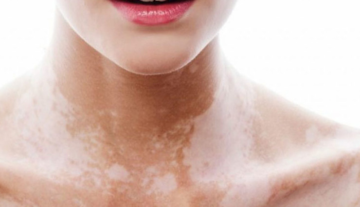 white spots,remedies for white spots,home remedies,ksin care tips,beauty tips