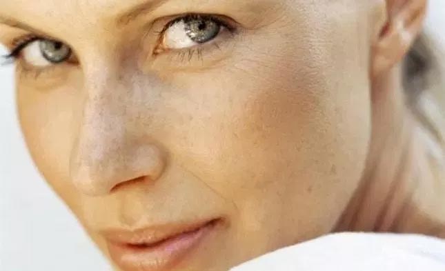 white spots on face,home remedies,skin care tips ,ब्यूटी टिप्स, ब्यूटी टिप्स हिंदी में, घरेलू उपाय, त्वचा पर सफ़ेद दाग, त्वचा के सफ़ेद दाग का इलाज, त्वचा की सुंदरता 