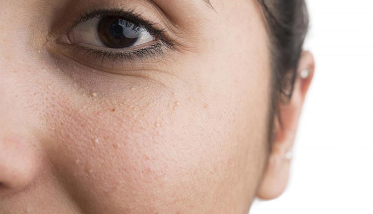त्वचा पर सफ़ेद दाग घटाते है आपकी सुंदरता, इनसे निजात पाने के लिए करें ये 5 घरेलू उपाय 